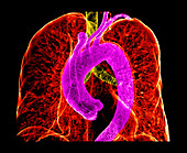 Enhanced Multidetector CT of Chest