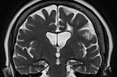 Alzheimer's Disease, MRI