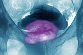 Prostate Cancer, X-ray