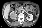 Renal Cancer, CT Scan
