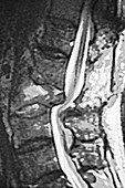 Lumbar Vertebrae Dislocation, MRI