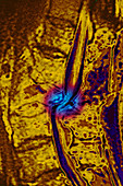 Lumbar Vertebrae Dislocation, MRI