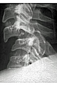 Cervical Vertebrae Dislocation, X-ray