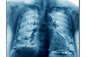 Lung Metastases, X-ray
