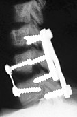 Vertebrae with Screws and Plates, X-ray