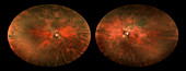 Bilateral Melanosis of Eye