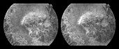 Metastatic Melanoma, stereo image