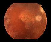 Metastatic Melanoma in Eye