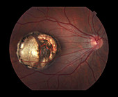 Retinal Coloboma