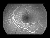 Branch Retinal Artery Occlusion, 4 of 5