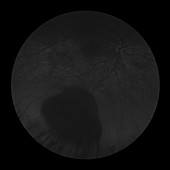 Choroidal Melanoma, 1 of 8