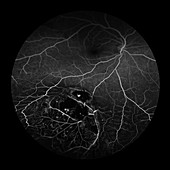 Choroidal Melanoma, 7 of 8