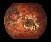 Choroidal Neovascular Membrane and Staphyloma