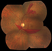 Proliferative Diabetic Retinopathy