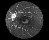 Crystalline Maculopathy