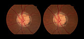 Optic Nerve Head Druzen, stereo image