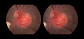 Capillary Hemangioma, stereo image