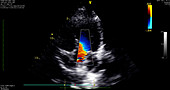 Echocardiogram