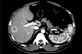Suppurative Adenopathy, Liver and Spleen, CT Scan