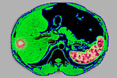 Suppurative Adenopathy, Liver and Spleen, CT Scan