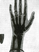 X-Ray of Girl's Hand, 1896