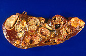 Carcinoid Liver, Gross Specimen