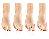 Gout in Foot, Illustration