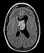 Brain Subependymoma, Axial FLAIR MRI