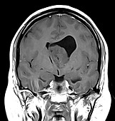 Brain Subependymoma, Coronal T1 weighted MRI