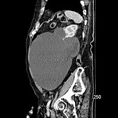 Giant Benign Renal Cyst, CT