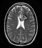 Cavernous Malformation of Brain, MRI