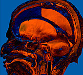 Enhanced Cadaver Sagittal Slice of Brain