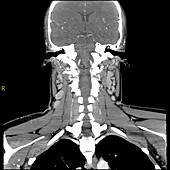 Enlarged Lymph Nodes, Infectious Mononucleosis, CT