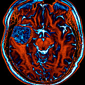 Cavernous Malformation, MRI