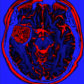 Cavernous Malformation, MRI