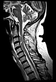 Cervical Spine Meningioma, MRI