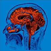 Sagittal Brain MRI
