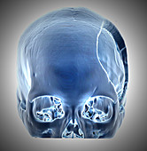 3D CT of Hemicraniectomy