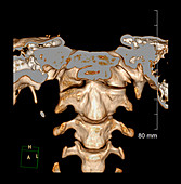 Congenital Assimilation of C1 to Skull Base, CT