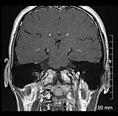 Congenital Assimilation of C1 to Skull Base, MRI