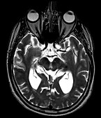Progressive Supranuclear Palsy (PSP), MRI