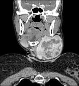 Large Thyroid Goiter, CT
