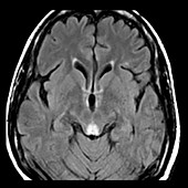 Wernicke's Encephalopathy, MRI