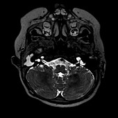 Cystic cochleovestibular anomaly (IP-I), MRI