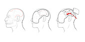 Decompressive Craniectomy, Illustration