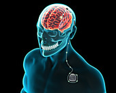 Deep Brain Stimulation, Illustration