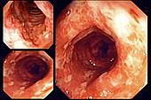 Crohn's Disease, Endoscopy