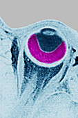 Retinal Detachment, MRI