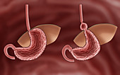 Normal Stomach & Stomach with Hiatal Hernia