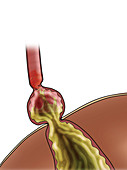 GERD and Hiatal Hernia, Illustration